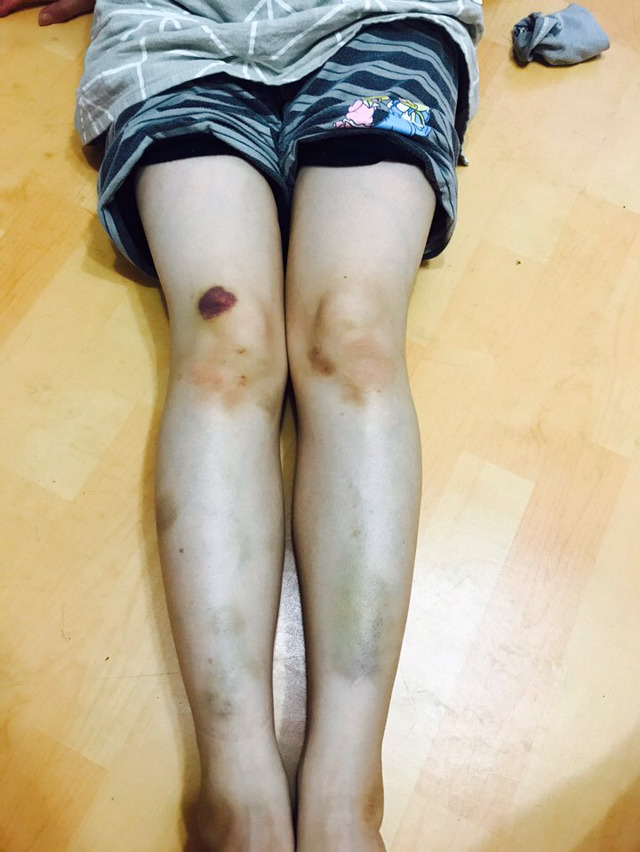 진돗개에게 물려 강아지와 어머님이 심각한 상태입니다. 뻔뻔한 가해견주의 태도를 한번만 봐주세요. (요약있음) (상처사진 주의) | 인스티즈