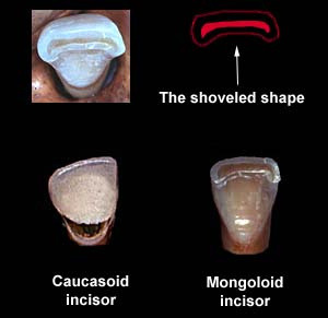 아시안(몽골로이드)에게서만 나타나는 치아 특징 | 인스티즈